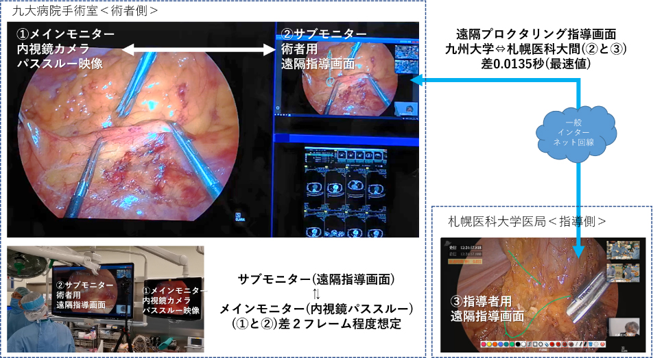 札幌・福岡間の離れた2拠点のディレイだけでなく、手術室内内視鏡映像と遠隔指導画面のディレイもほとんど気にならない程度に 調整できた